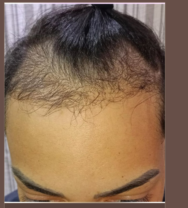 Evolução da linha frontal após 6 meses de acompanhamento